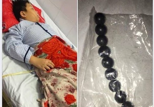 Bé trai 10 tuổi hoại tử ruột vì bị bạn ép nuốt 9 viên bi sắt? Bé trai 10 tuổi hoại tử ruột vì bị bạn ép nuốt 9 viên bi sắt?