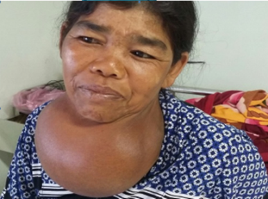 Phẫu thuật bướu khổng lồ 35 năm trên cổ một phụ nữ Phẫu thuật bướu khổng lồ 35 năm trên cổ một phụ nữ