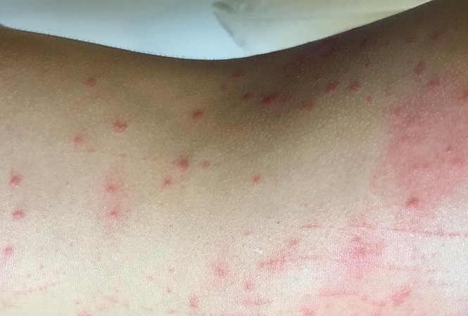 Nhiều người bị ngứa, nổi mẩn đỏ khi tắm biển Đà Nẵng Sau khi tắm biển về, nhiều người bị ngứa, nổi mẩn. Ảnh: Đ.N