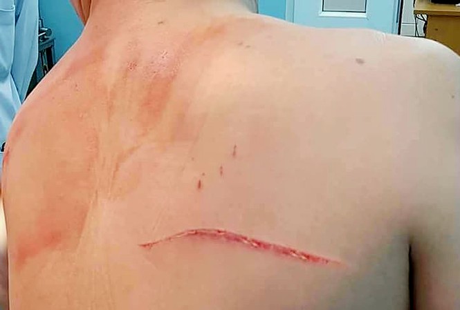 Bắt kẻ chém bác sĩ Chiêm Quốc Thái giữa phố đi bộ Vết chém kéo dài trên lưng bác sĩ Chiêm Quốc Thái.