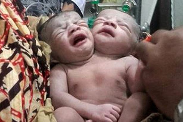 Bé gái mới sinh có 1 thân, 2 đầu gây xôn xao ở Bangladesh Em bé hai đầu mới sinh ở Bangladesh.