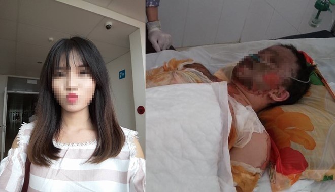 Cô gái bị bỏng toàn thân do TNGT đã tử vong Sau vụ tai nạn Hằng bị bỏng toàn thân, khuôn mặt biến dạng và hai tay cháy khô