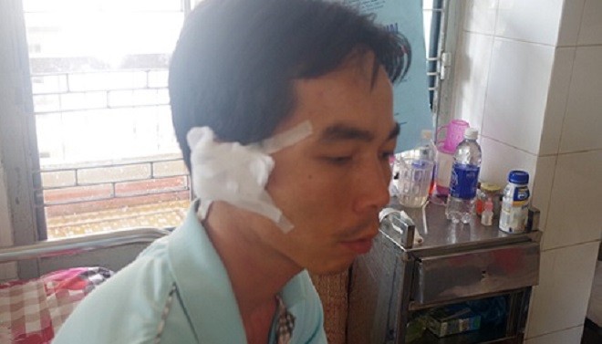 Đang làm nhiệm vụ, Phó Công an xã bị côn đồ chém lìa tai Anh Luận đang điều trị tại bệnh viện đa khoa tỉnh Đắk Lắk.