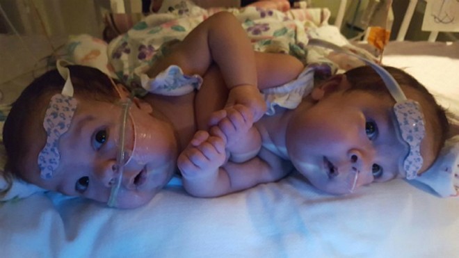 Mổ tách cặp song sinh gái dính liền tim Cặp song sinh Scarlett và Savannah trước khi được chia tách. Ảnh: University Florida Health Shands Children’s Hospital.