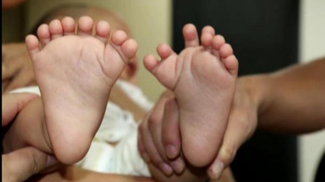 Kỳ lạ em bé có đến 31 ngón tay và chân Bé trai có tổng cộng 16 ngón trên bàn tay và 15 ngón chân nhưng lại không có ngón tay cái hay ngón chân cái nào.