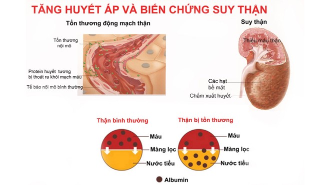 Bệnh tăng huyết áp có thể dẫn đến suy thận Ảnh minh họa