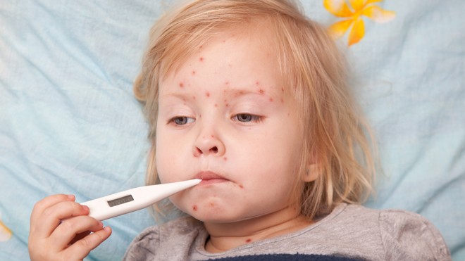 Cảnh báo: Nguy cơ tử vong do thủy đậu Thủy đậu thường “tấn công” trẻ nhỏ