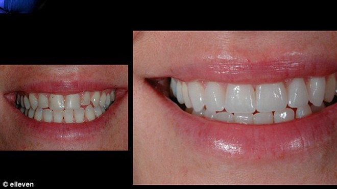 Làm đẹp răng chỉ trong một ngày Làm đẹp răng chỉ trong một ngày