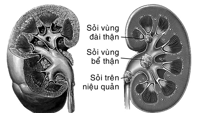 Sỏi thận - Ngăn ngừa tái phát trong điều trị Sỏi thận - Ngăn ngừa tái phát trong điều trị