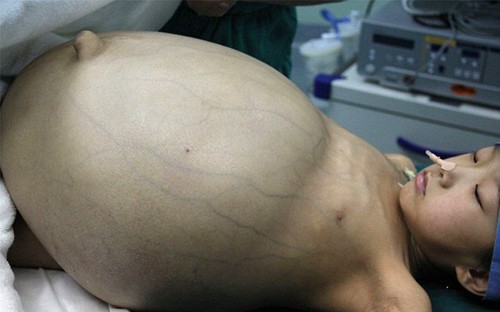 Bé gái được cắt bỏ u buồng trứng nặng gần 15 kg Khối u có kích thước lớn hơn hai quả bóng đá và nặng gần 15 kg. Ảnh: Getty Images.