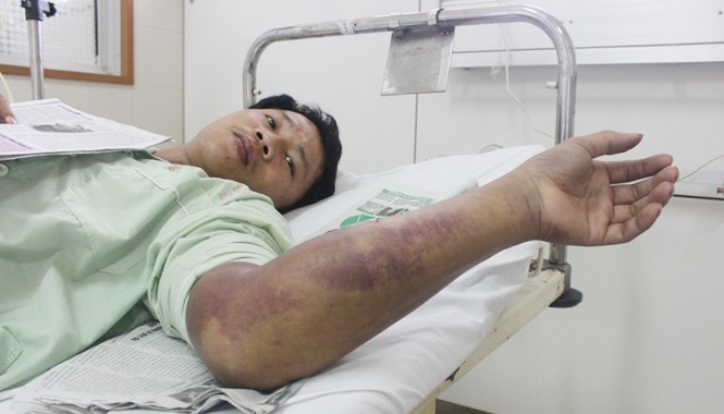 Cứu sống hơn chục người bị rắn lục đuôi đỏ cắn Bệnh nhân Hoàng Minh Quang đang được điều trị tại khoa Hồi sức cấp cứu, bệnh viện TW Huế.