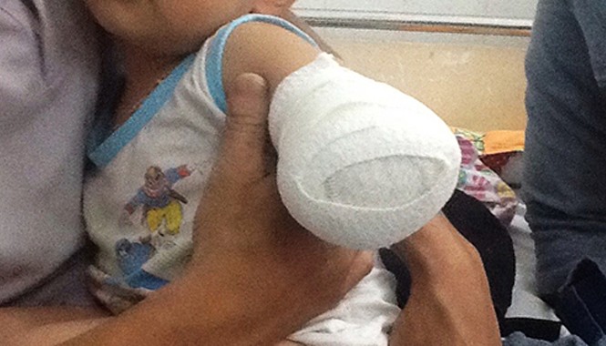 Xót xa, bé trai 2 tuổi bị cối xay nghiến nát bàn tay Cánh tay của bé sau tai nạn. Ảnh: Thiên Chương.