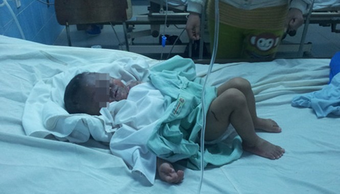 Bé 20 tháng tuổi bỏng nặng bởi nồi cháo của mẹ Cháu bé bị bỏng đang điều trị tại bệnh viện.