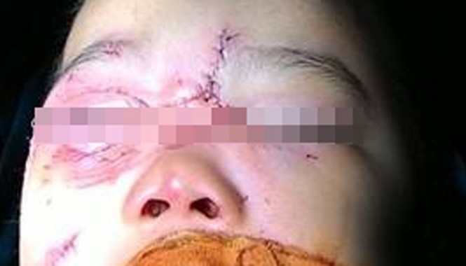 Bé 3 tuổi bị chó nhà cắn rách mặt Ảnh: Bệnh viện Nhi Trung ương.