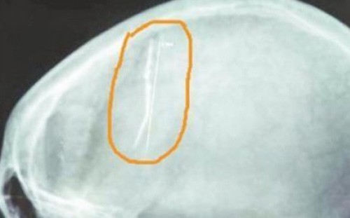 Chiếc kim gỉ trong não bệnh nhân suốt nhiều năm Hình ảnh trên phim chụp cho thấy cây kim ở trong đầu bệnh nhân. Ảnh: SCMP.
