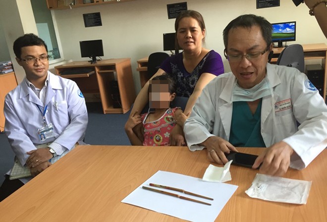 Hãi hùng bé gái 9 tuổi bị đũa đâm thủng lưỡi Đôi đũa được lấy ra khỏi miệng bé Ngọc Anh. Ảnh: Quốc Ngọc