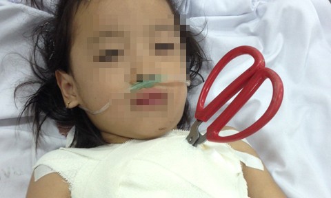 Bé gái 5 tuổi vấp ngã bị kéo đâm vào ngực lút cán Cây kéo đã đâm lút cán vào ngực bé, mũi dao nằm ngay giữa trung thất.