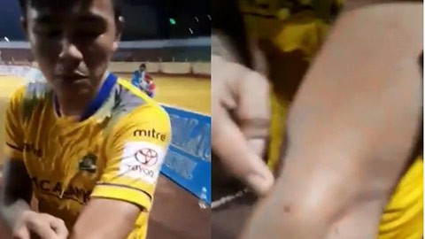 V.League tái hiện vụ Suarez cắn tay Ivanovic V.League tái hiện vụ Suarez cắn tay Ivanovic