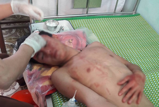 Khởi tố nhóm thanh niên xông vào trường đánh thầy trò nhập viện Em Tài điều trị tại bệnh viện.