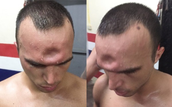 Lĩnh đòn tàn khốc, võ sĩ Muay Thái lõm trán Jeremy bị lõm trán sau khi lĩnh trọn cú thúc cùi chỏ của đối thủ.