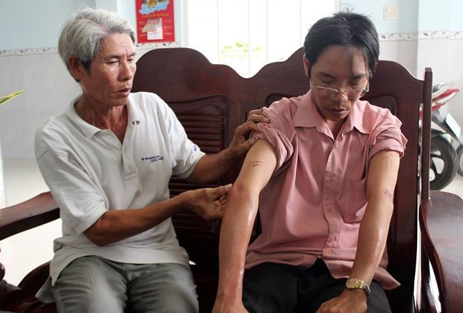 Bản tin 20H: Công an vào cuộc vụ chủ tiệm vàng bị cướp 2,5 tỷ Anh Truyền với vết tích của roi điện tấn công.