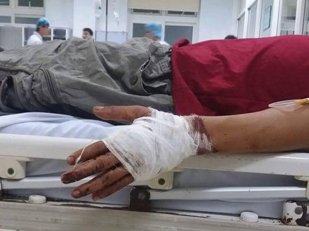 Tranh khách, chủ thuyền chém đối thủ lìa tay trên đảo Ông Lý được các bác sỹ nối lại bàn tay bị đứt lìa.