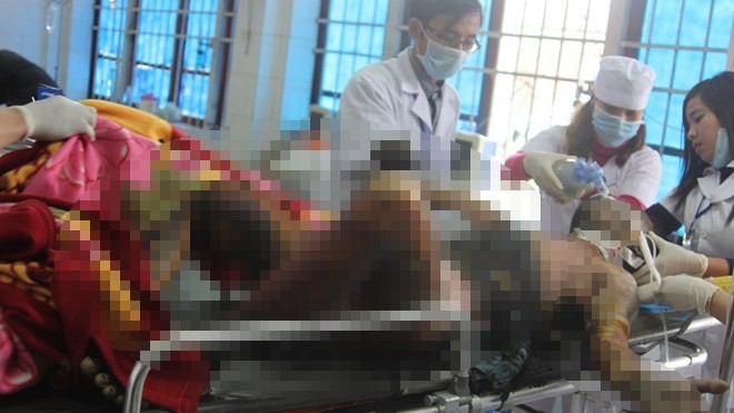 Tưới xăng tự thiêu, nam thanh niên nguy kịch Hồ Sỹ Huy bị cháy toàn thân đang được cấp cứu tại bệnh viện