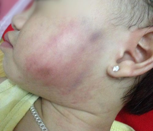 Bé 16 tháng bị cô giáo tát tím má vì không chịu ăn Vết bầm trên má bé 16 tháng tuổi khi gia đình đón về vào chiều 26/5.