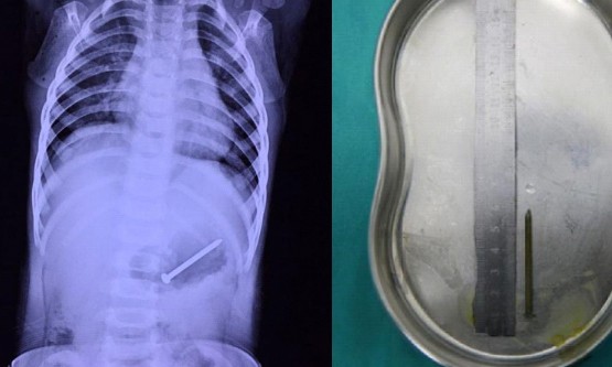 Bé trai 1 tuổi nuốt đinh 5cm vì bà chủ quan đưa cho chơi Chiếc đinh bị bé trai nuốt.