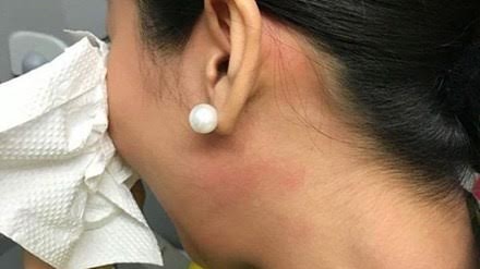 Tiếp viên bị chấn động tâm lý sau cú ra đòn của khách VIP Tiếp viên T sau khi bị ông Mai Thanh Bình đánh