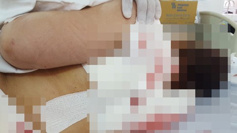 Đâm vợ trọng thương giữa đường vì nghi ngoại tình Chị Bé Hai được đưa vào Bệnh viện đa khoa tỉnh Vĩnh Long cấp cứu. Ảnh: Vietnamnet