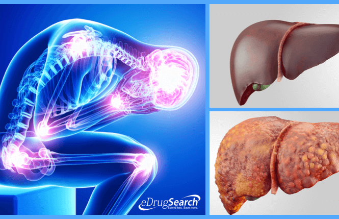 4 triệu chứng bệnh gan nhiễm mỡ không thể bỏ qua Ảnh minh họa: eDrugSearch.com