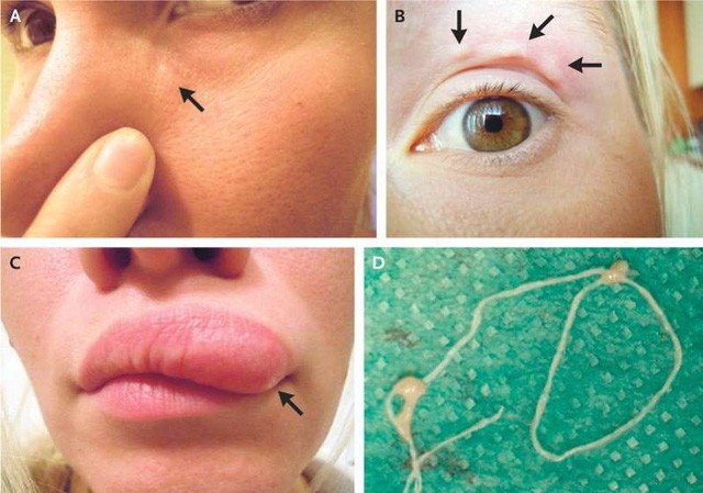Cô gái Nga bị... giun chạy lung tung trên mặt do muỗi đốt Người phụ nữ mà trước đó mới đi chơi ở ngoại ô Moscow và bị nhiều vết muỗi đốt…