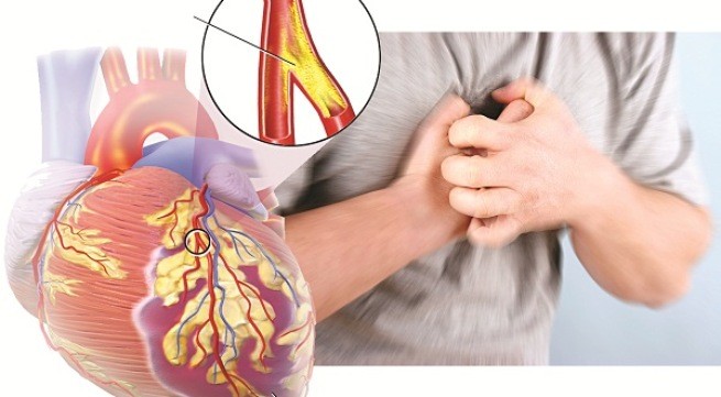 Dấu hiệu sớm cảnh báo bệnh động mạch vành Ảnh minh họa: SucKhoeDoiSong