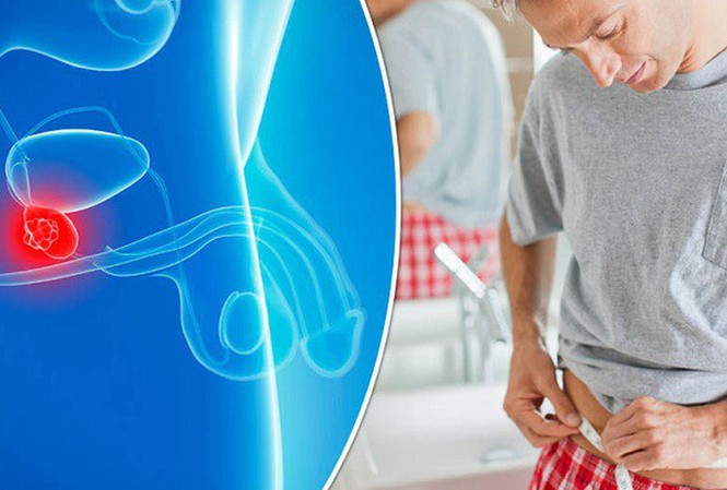 Làm thế nào phát hiện sớm ung thư tuyến tiền liệt? Làm thế nào phát hiện sớm ung thư tuyến tiền liệt?