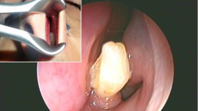 Sửng sốt phát hiện răng mọc… trong mũi Ảnh chụp chiếc răng nằm trong hốc mũi nam thanh niên.