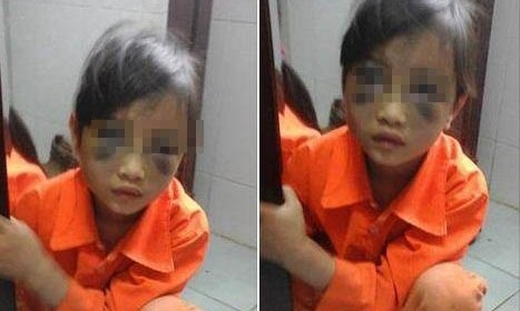 Công an triệu tập cô giáo đánh học sinh thâm tím mặt Em P.C.Th. bị thương thâm tím vùng mặt - Ảnh: Facebook