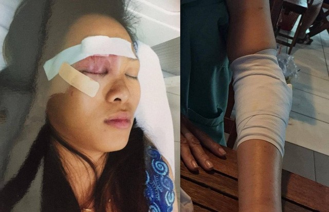 20 thanh niên vác mã tấu truy sát kinh hoàng trước Bệnh viện Từ Dũ Chị Tuyết với vết thương ở vùng mặt và cánh tay bị gãy của bà Thủy