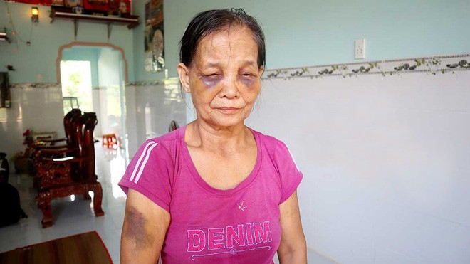 Con dâu bị tố đánh mẹ chồng sưng mặt sau khi cãi vã Khuôn mặt bầm tím của bà Tạo. Ảnh: Báo Bình Phước