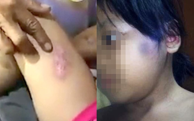 Bé gái 6 tuổi bị châm thuốc lá vào người Bé gái 6 tuổi bị châm thuốc lá vào người