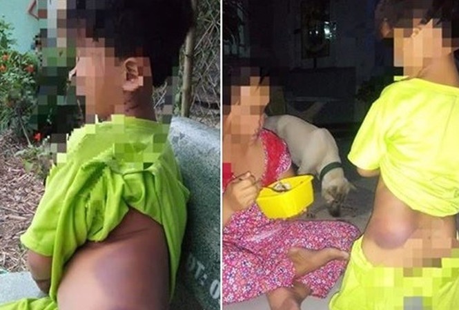 Học sinh Long An bị đánh tím bầm, Giám đốc Sở Giáo dục nhận thiếu sót Vết thương trên cơ thể K nghi do cô giáo đánh
