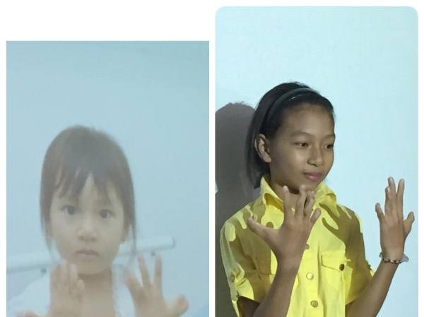 8 bệnh nhân dị tật bàn tay bẩm sinh sẽ được phẫu thuật miễn phí 8 bệnh nhân dị tật bàn tay bẩm sinh sẽ được phẫu thuật miễn phí