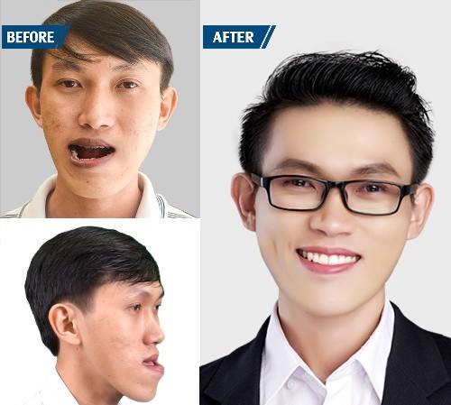 Tài xế grab có bằng thạc sĩ và cuộc lột xác từ bỏ nỗi đau ‘mặt khỉ’ Tài xế grab có bằng thạc sĩ và cuộc lột xác từ bỏ nỗi đau ‘mặt khỉ’