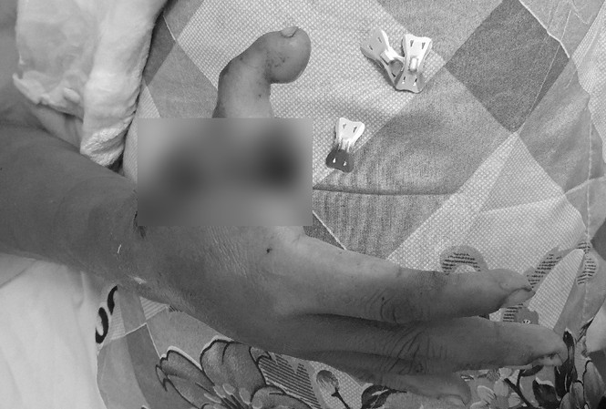 Phẫu thuật ‘dời’ ngón chân lên làm ngón tay cái cho nam bệnh nhân Phẫu thuật ‘dời’ ngón chân lên làm ngón tay cái cho nam bệnh nhân