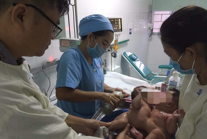 Mổ tách đôi bé song sinh dính liền phần gan Mổ tách đôi bé song sinh dính liền phần gan