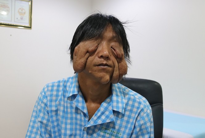 Mang khối u khổng lồ như 'mặt quỷ', người đàn ông 17 năm không dám ra khỏi nhà Mang khối u khổng lồ như 'mặt quỷ', người đàn ông 17 năm không dám ra khỏi nhà