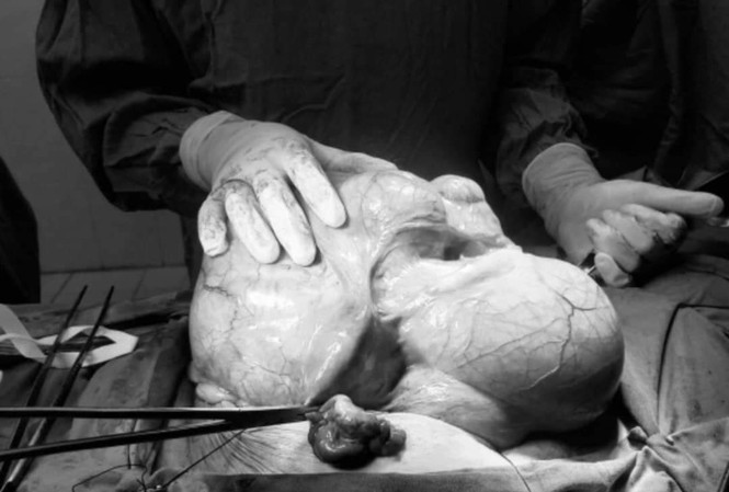 Người phụ nữ mang khối u hơn 6kg trong bụng nhưng không hay biết Người phụ nữ mang khối u hơn 6kg trong bụng nhưng không hay biết