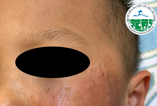 Bé trai 4 tuổi da bỏng rộp vì đồ chơi Halloween Bé trai 4 tuổi da bỏng rộp vì đồ chơi Halloween