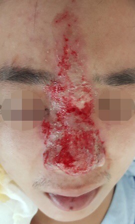 Mù mắt vì tiêm filler nâng mũi Mù mắt vì tiêm filler nâng mũi