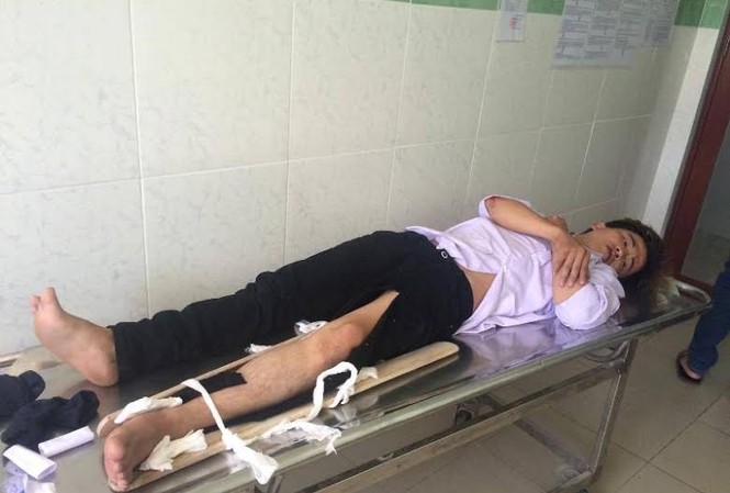 Xuống đường ra hiệu dừng xe, CSGT bị tông gãy chân Một trong hai thanh niên lao xe vào CSGT đang được điều trị tại bệnh viện. Ảnh C.Thạch